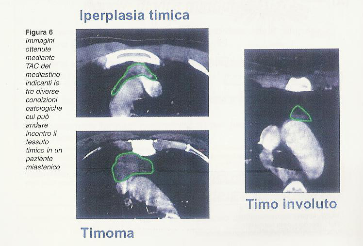 Iperplasia timica